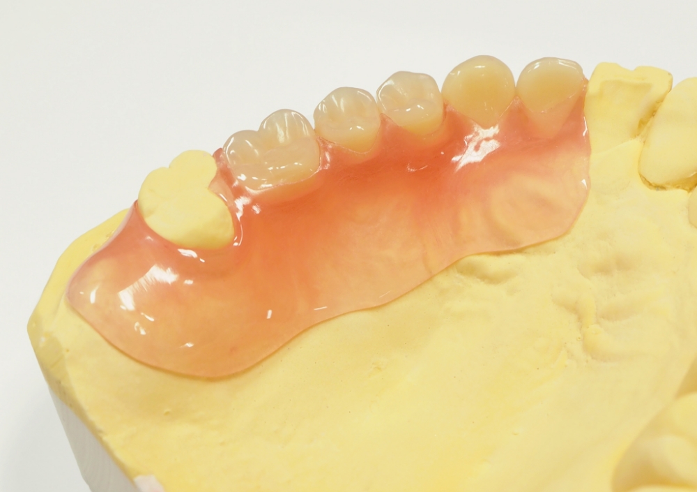 ノンクラスプデンチャー（自費）